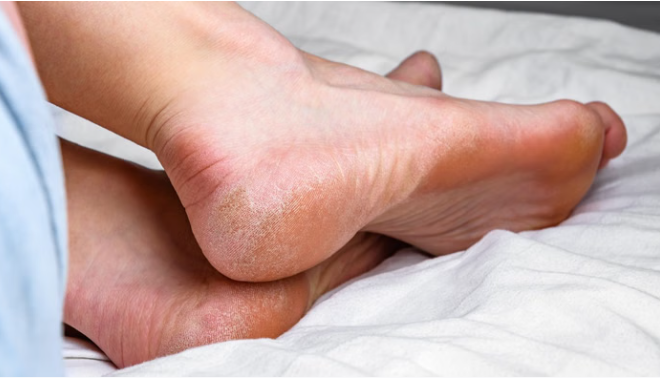 बारिश के मौसम में नमी की वजह से पैरों की त्वचा पर पड़ता हैं बुरा असर